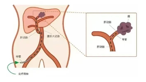 中晚期肝癌治療新選擇：肝動(dòng)脈灌注化療（HAIC）